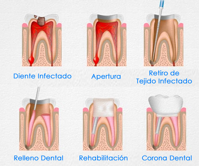 endodoncia-en-trujillo